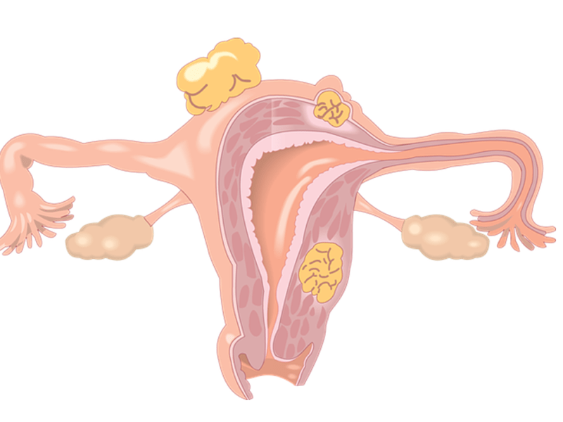 Fibromul uterin si&nbsp;Histerectomia
