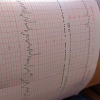 CTG-ul in sarcina: monitorizarea batailor cardiace&nbsp;fetale
