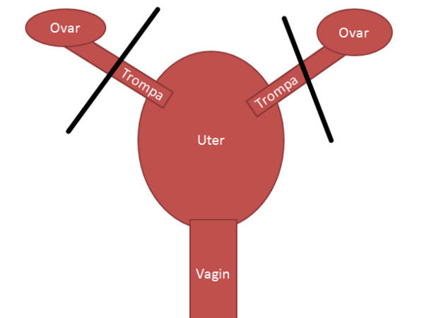 Legarea trompelor – anticoncepția&nbsp;definitivă